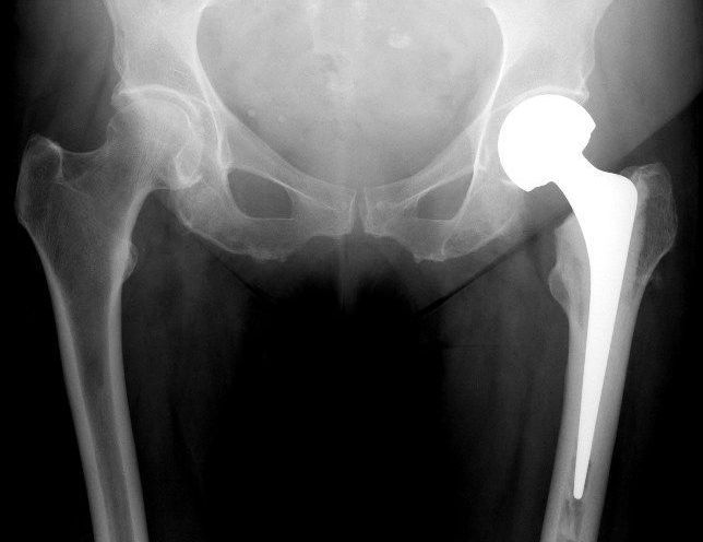 Total Hip replacement(posterior approach): Cemented Exeter