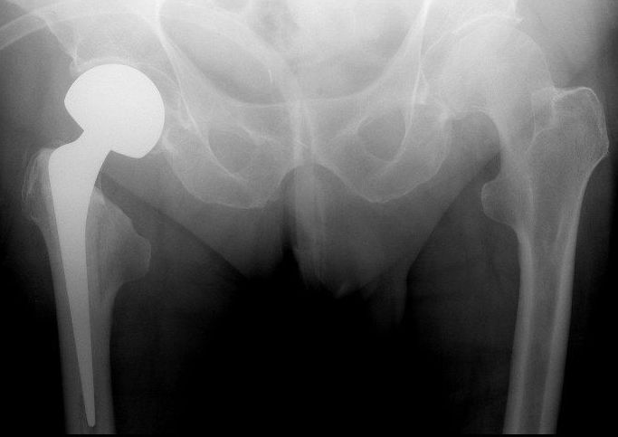 Total Hip replacement(posterior approach): Cemented Exeter