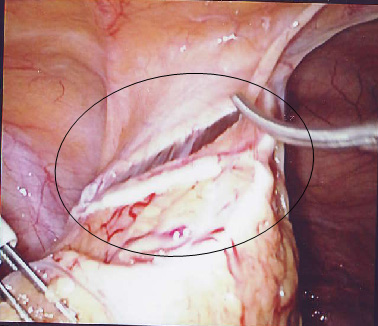  problems arising with the LNG-IUS use4 is similar to that for IUD use3.