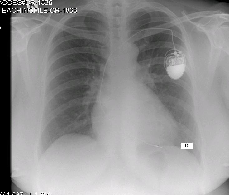 Single chamber pacemaker x ray